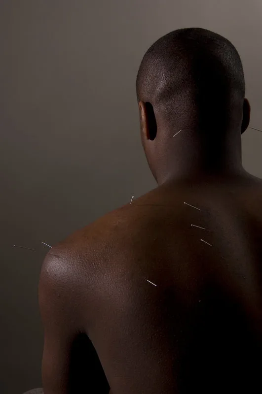 Patient receiving acupuncture on their shoulder/back